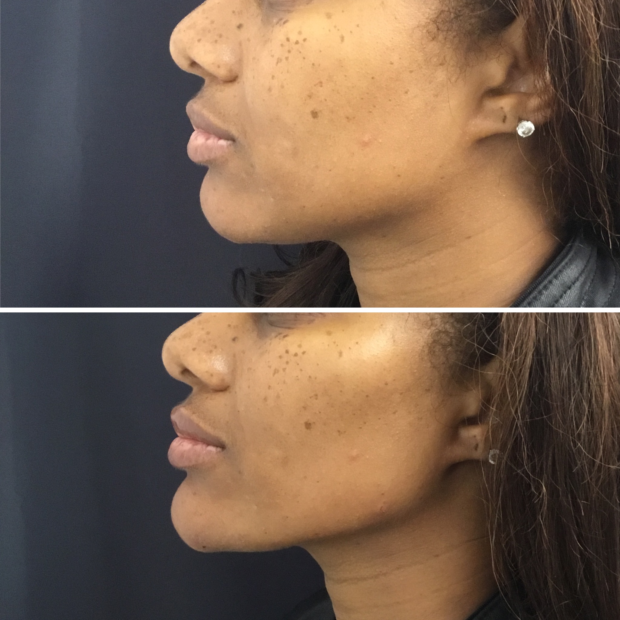 Jawline Contouring  Virginia, Washington D.C. and Maryland