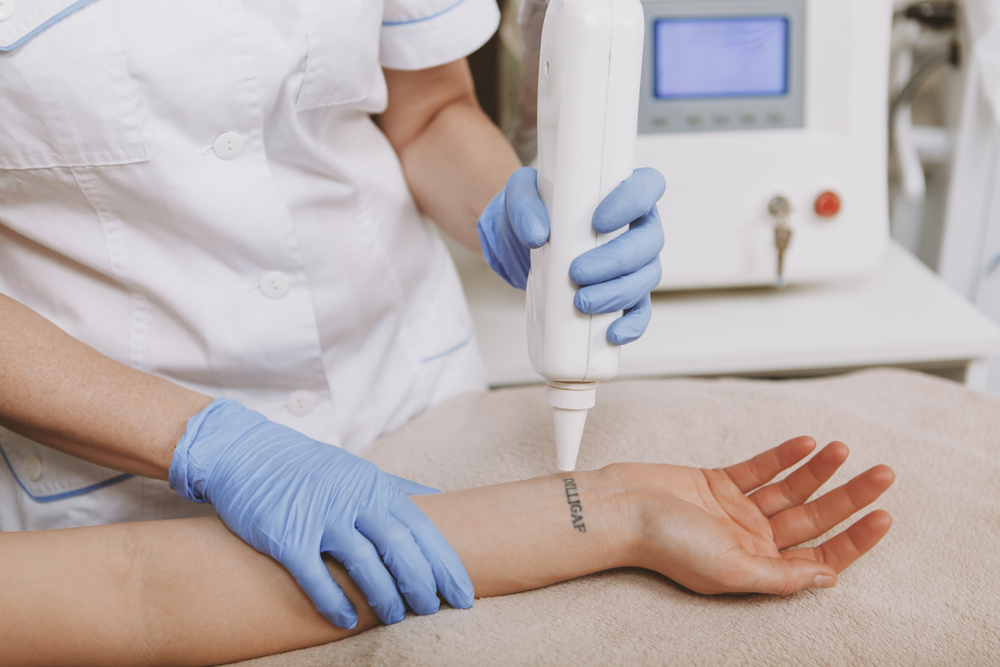 How Much Does the Best Tattoo Removal Cost in Tysons Corner?
