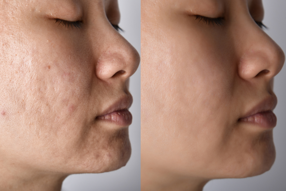 Skin Resurfacing for Wrinkles and Scars Near Reston