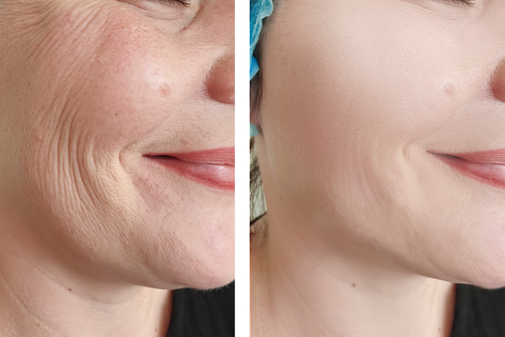 Best Non-Invasive Skin Tightening Near Tysons Corner, Virginia