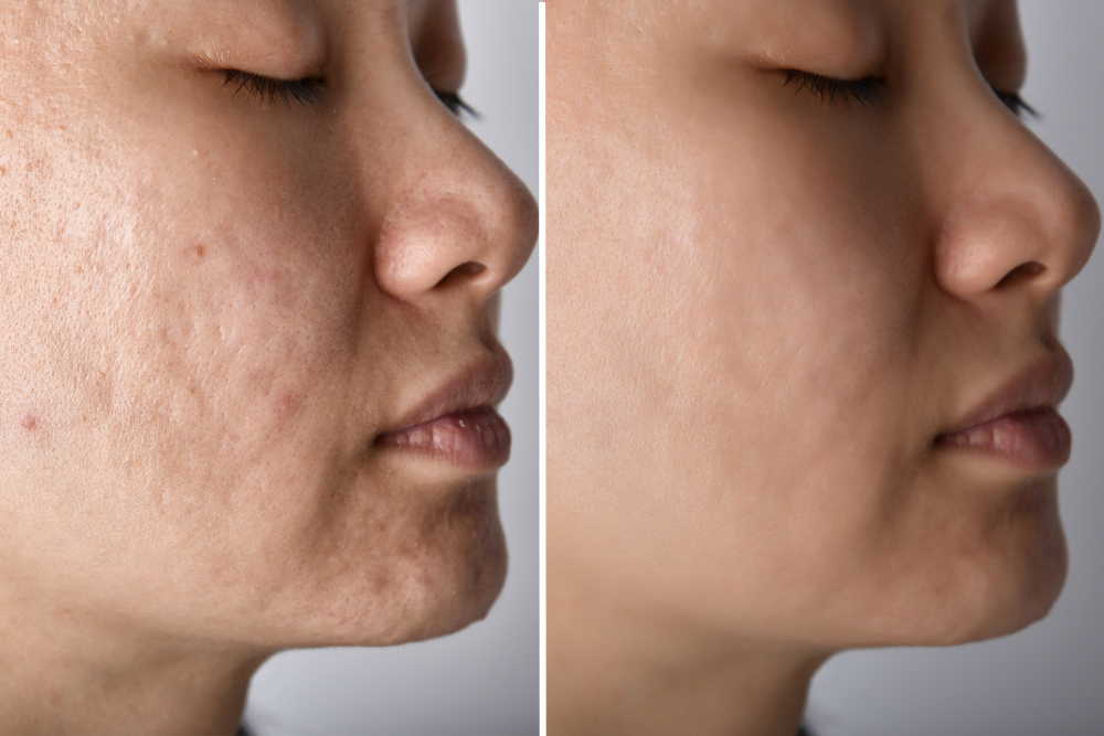 Microneedling Treatment Near McLean, VA