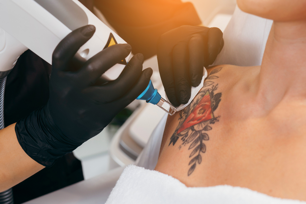 Advanced Tattoo Removal Technology in Fairfax, VA: How It Works