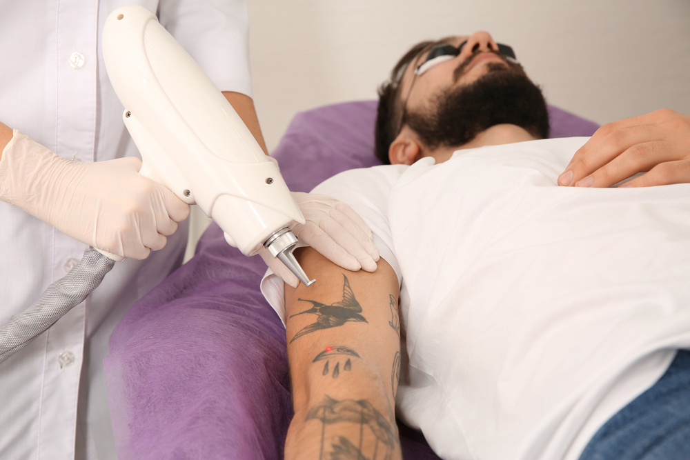 How to Find a Top-Rated Provider for Laser Tattoo Removal in Alexandria, Virginia