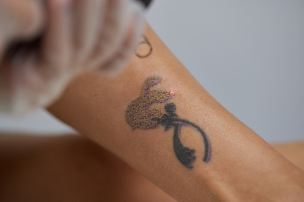 Wondering How to Get Safe and Effective Tattoo Removal in Arlington, VA? Click Here!
