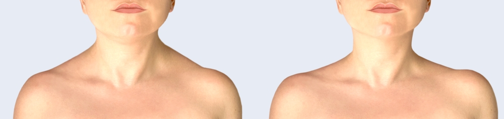 TrapTox Near Vienna, McLean and Tysons Corner, VA: Benefits, Results and What to Expect