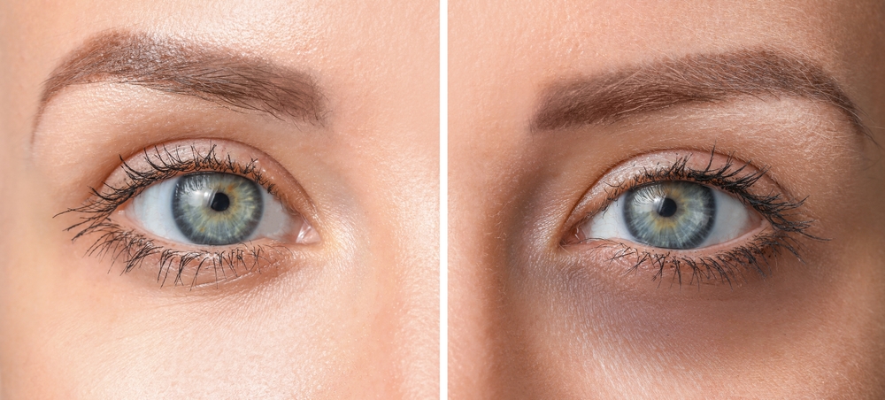 PDGF Under-Eye Treatment in Tysons Corner, VA: A Regenerative Alternative to Traditional Under-Eye Fillers