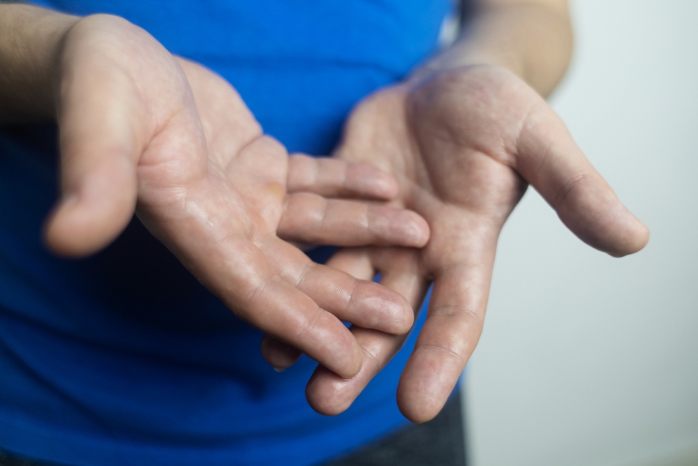 Botox for Excessive Hand Sweating